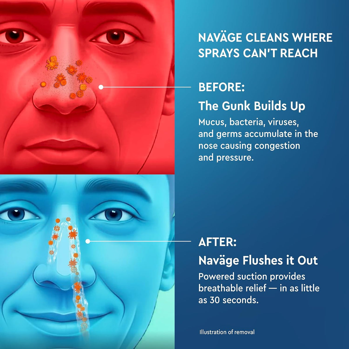 NAVAGE® Deluxe Bundle: Nose Cleaner, 30 SaltPods, Caddy, Black Bag | Deluxe Set: Powered Nose Sinus Cleaner, Storage Caddy, Batteries & Matching Black Travel Bag for Congestion & Sinus Relief