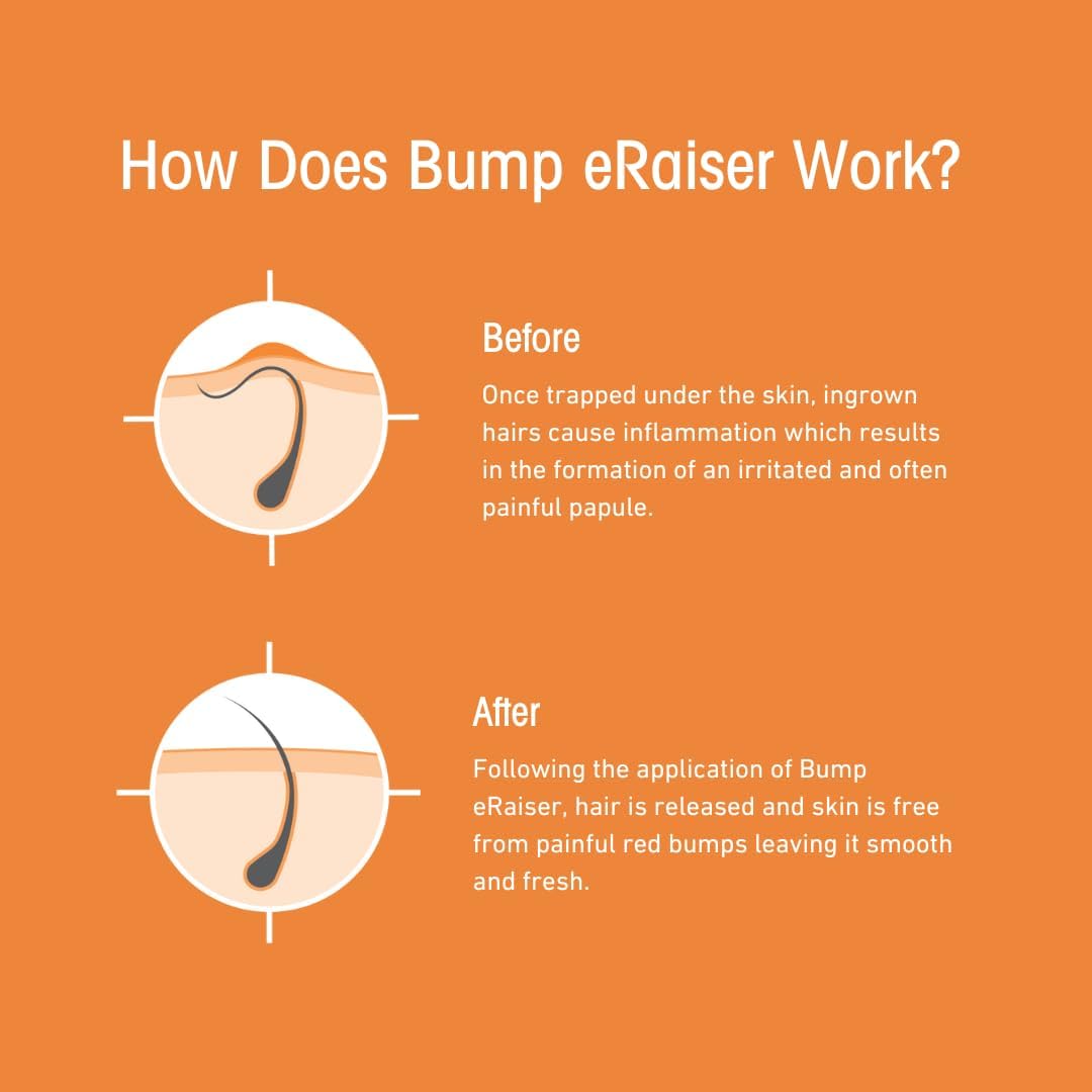 Bump eRaiser 5 Pack – The Complete Ingrown Hair Care Kit in One Convenient Pack