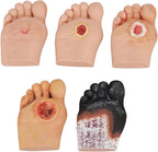 Diabetiker Wound Dressings and Gauze