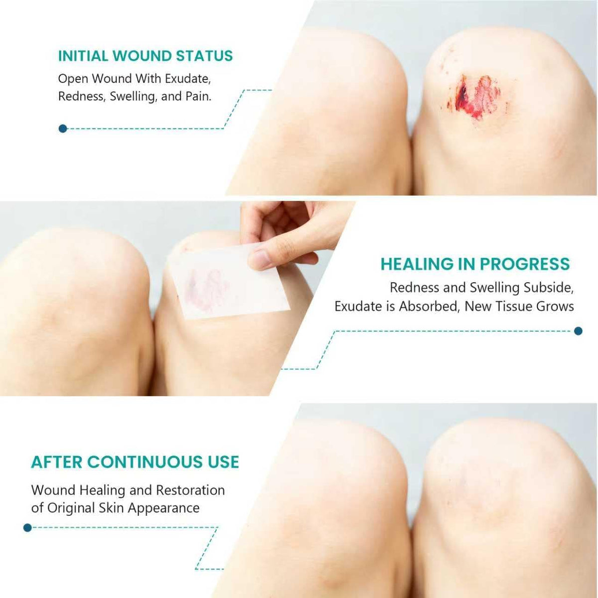 Medical-Grade Hydrocolloid Roll for Wound Care: 5cm × 3.6m Hydrocolloid Bandages, Cut-to-Size Self-Adhesive Patch Dressing, Waterproof & Ultra Absorbent Tape for Burns, Blisters, Acne, First Aid Kit