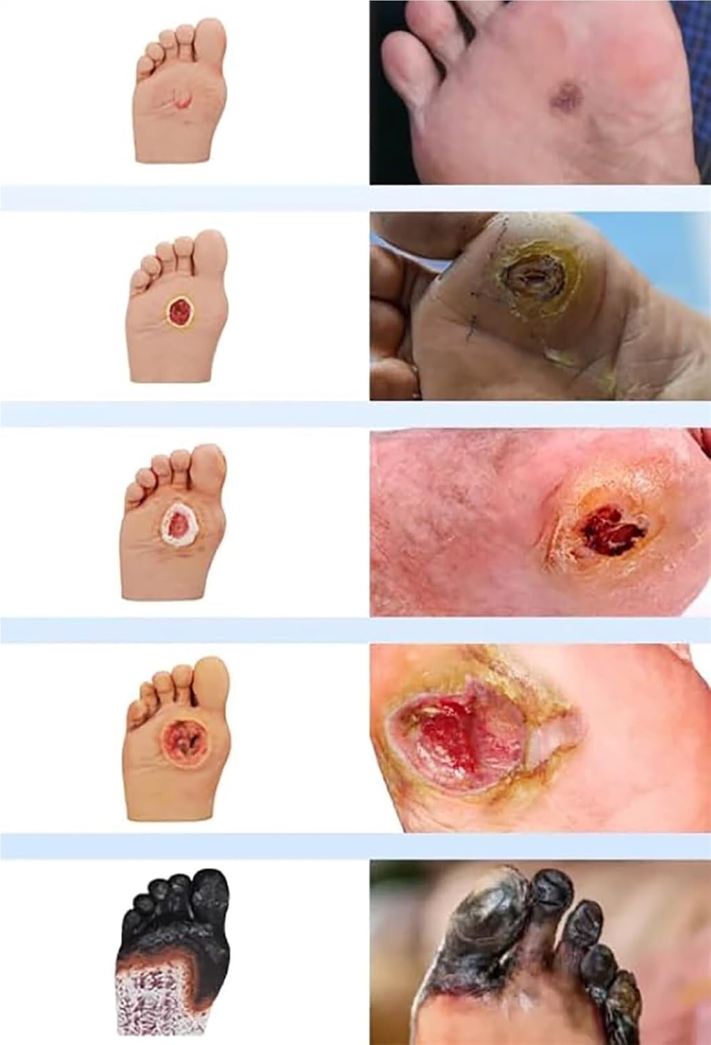 Diabetiker Wound Dressings and Gauze