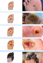 Diabetiker Wound Dressings and Gauze
