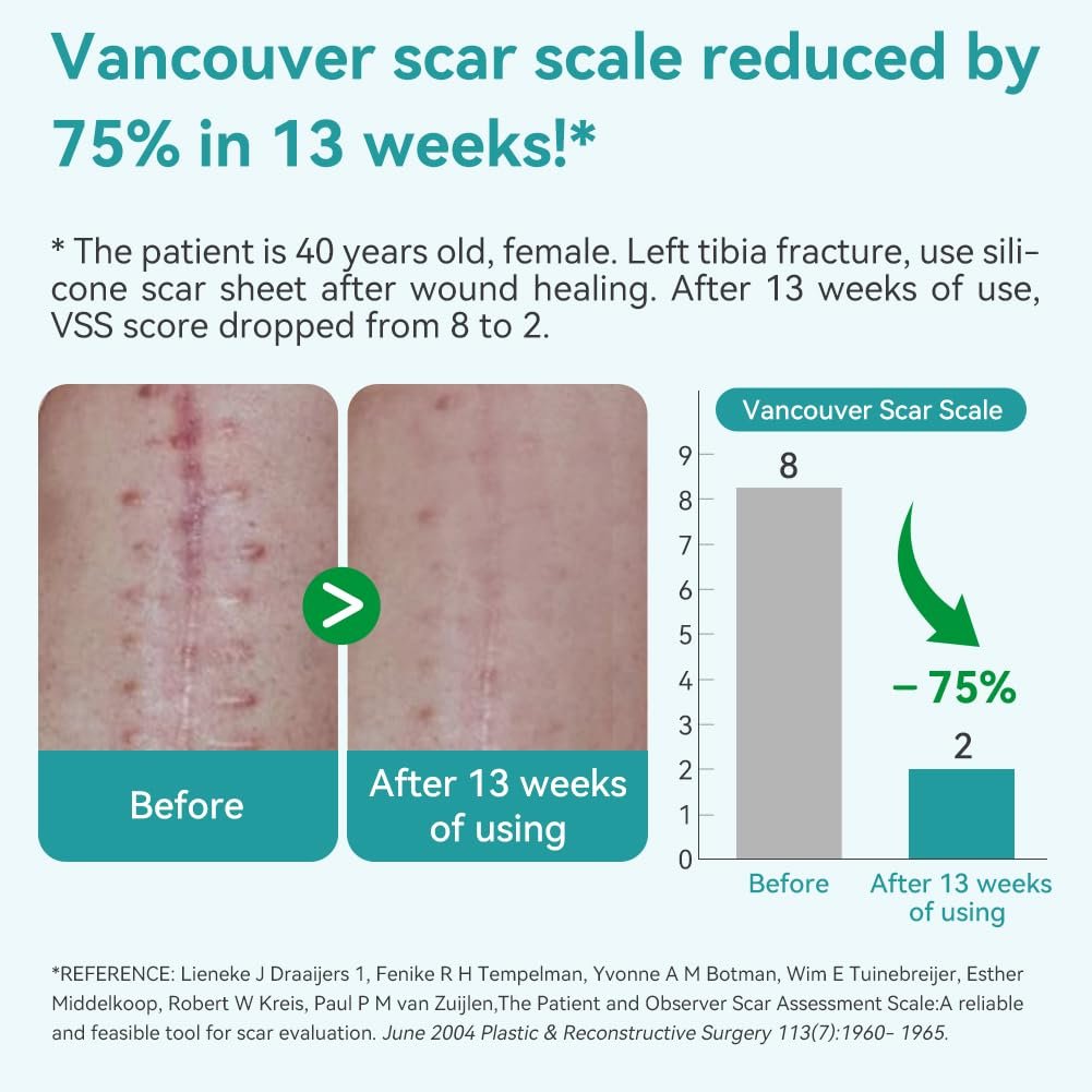 Dimora Medical Grade Silicone Scar Sheets, 1.6"x120" Roll