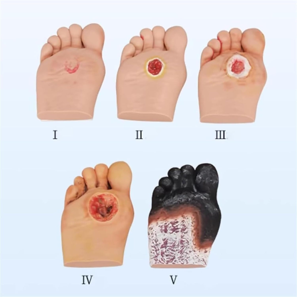 Diabetiker Wound Dressings and Gauze