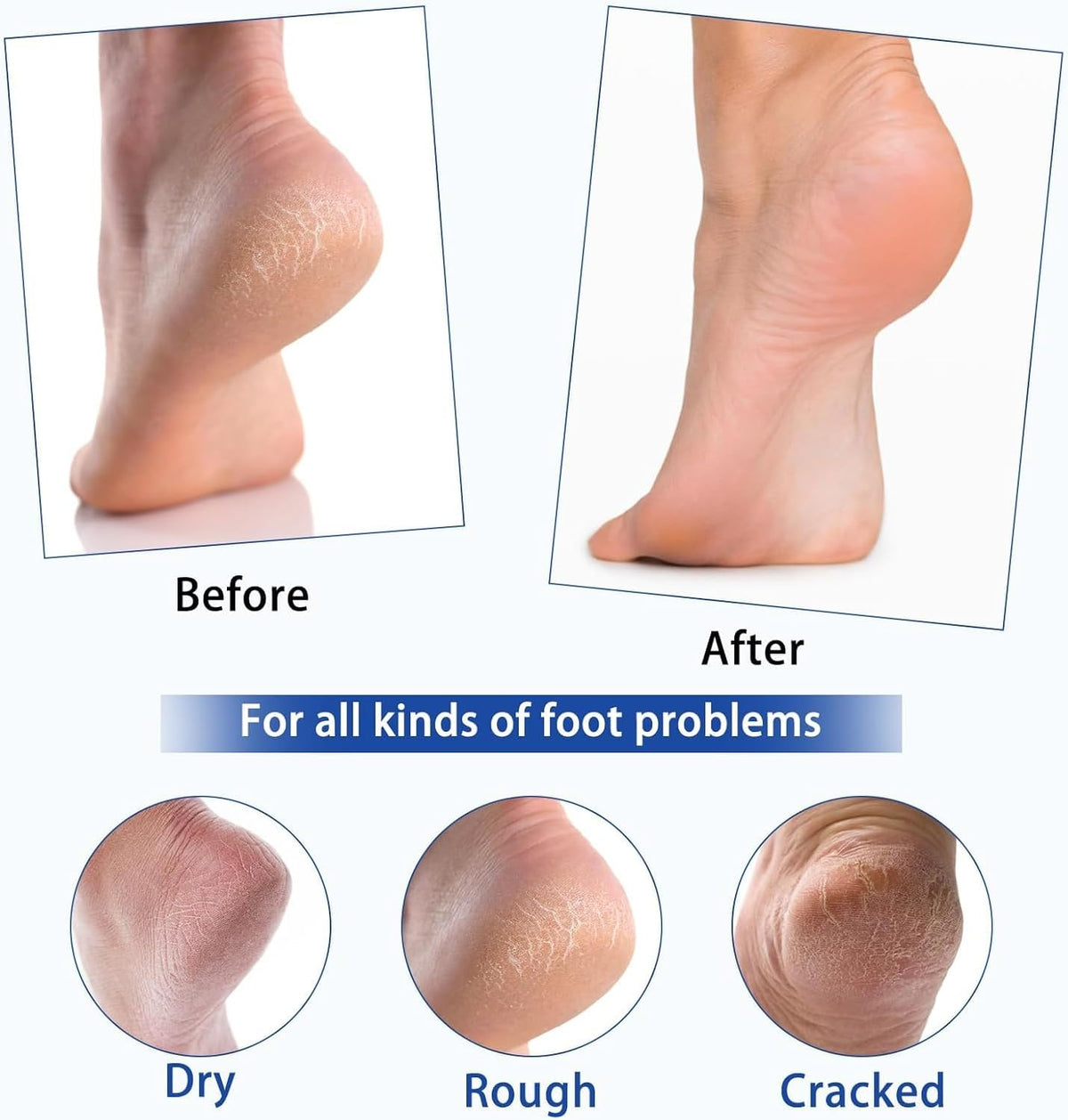 Urea Cream 40%, Keratolytic Foot Cream for Dry Cracked Heels, Feet, Knees, Elbows, Hands, Cuticle, Callus Remover, Skin Barrier Repair