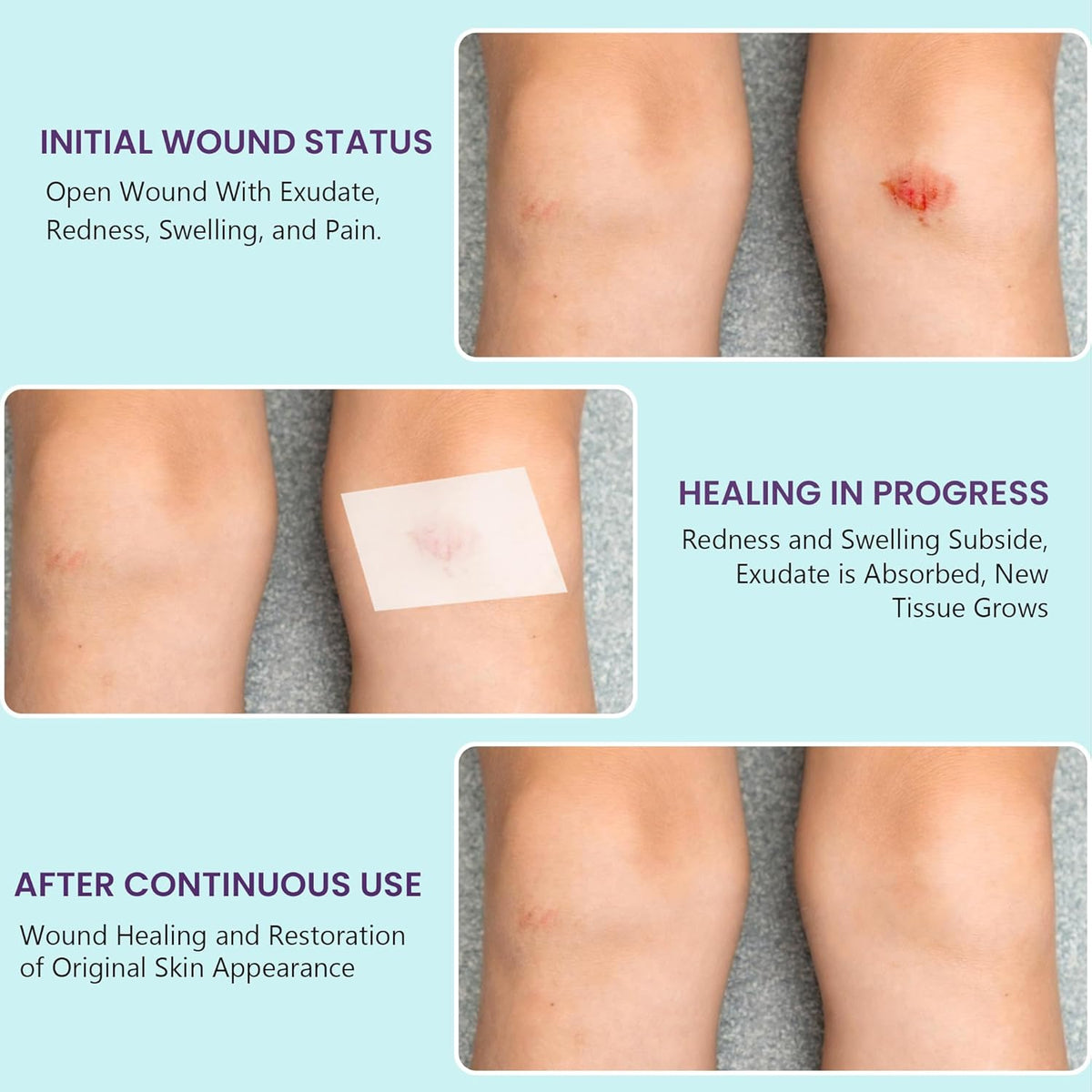 Medical-Grade Hydrocolloid Roll for Wound Care: 5cm × 1.5m Hydrocolloid Bandages, Cut-to-Size Self-Adhesive Patch Dressing, Waterproof & Ultra Absorbent Tape for Burns, Blisters, Acne, First Aid Kit