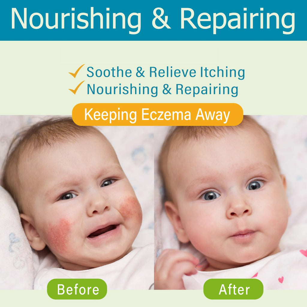 Baby Eczema Cream - Kids Eczema Therapy & Relief Body Cream, Nourishing Skin Protectant Soothes & Relieves Dry, Hypoallergenic, Fragrance & Steroid-Free (100ml_1pcs)