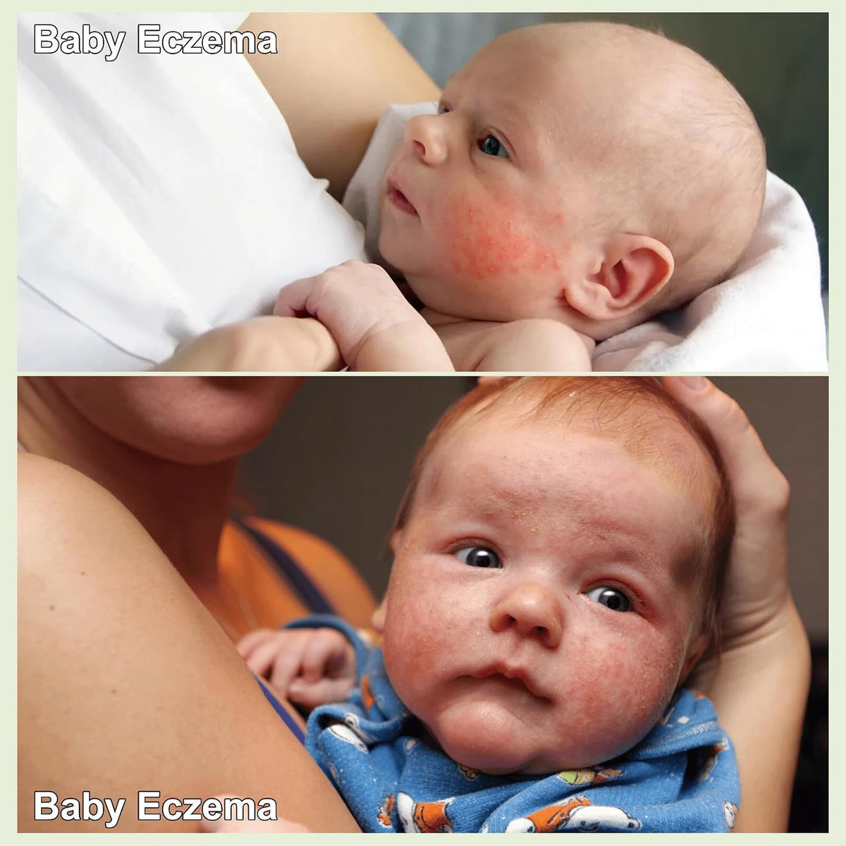 Baby Eczema Cream - Kids Eczema Therapy & Relief Body Cream, Nourishing Skin Protectant Soothes & Relieves Dry, Hypoallergenic, Fragrance & Steroid-Free (100ml_1pcs)