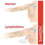 Lymphedema Arm Sleeve (Single) - Compression Stocking Recommended by Doctors, For Post-Mastecomy & Lymphoedema of Hand and Arm, Extra-Firm Graduated Compression (For Women & Men)