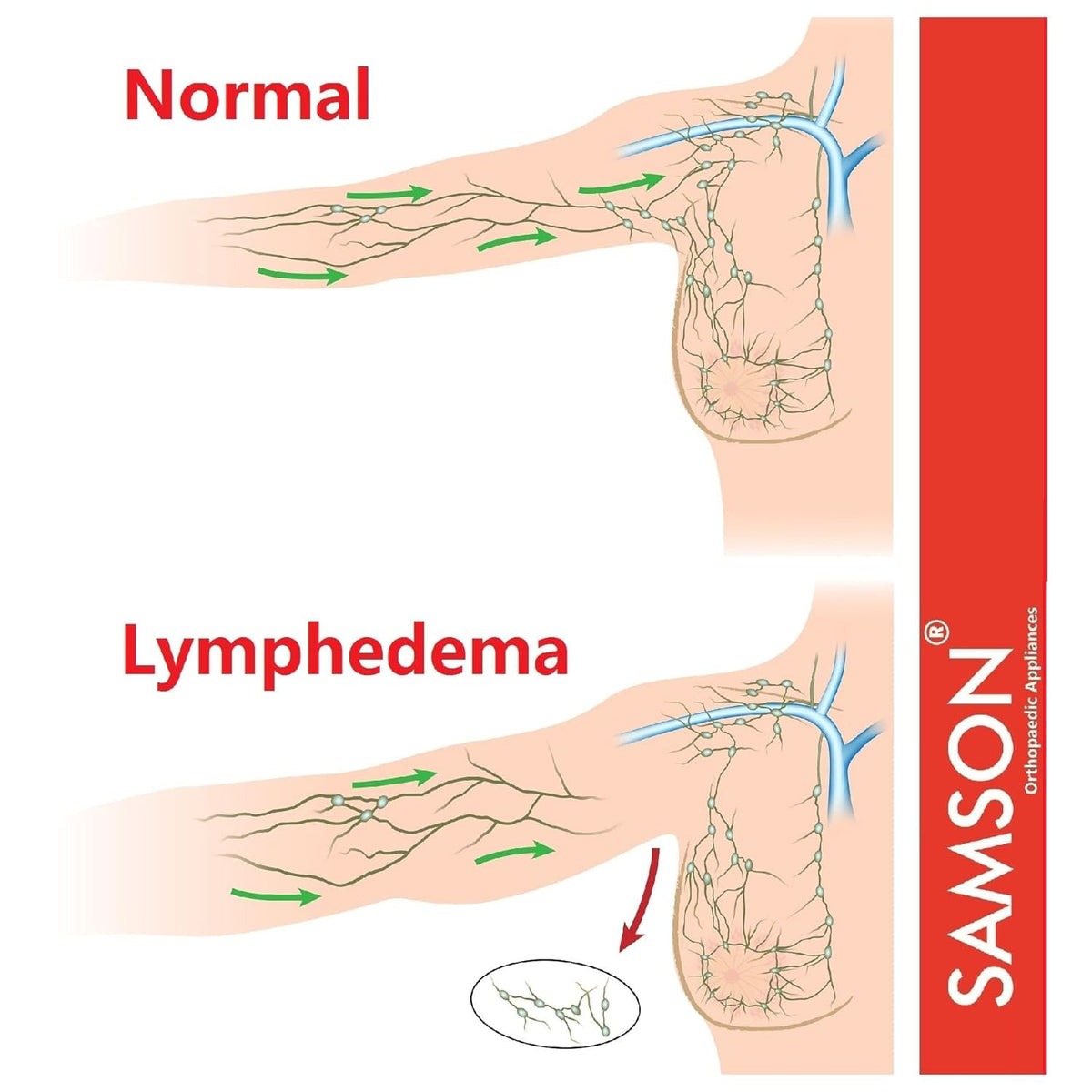 Lymphedema Arm Sleeve (Single) - Compression Stocking Recommended by Doctors, For Post-Mastecomy & Lymphoedema of Hand and Arm, Extra-Firm Graduated Compression (For Women & Men)