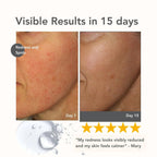 Riversol Rosacea Treatment for Face | Anti-Redness Serum for Sensitive Skin | Calming Redness Relief | Vitamin C & E | Anti-Aging Formula | Fragrance Free | Dermatologist Developed | Made in Canada