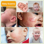 Baby Eczema Cream - Kids Eczema Therapy & Relief Body Cream, Nourishing Skin Protectant Soothes & Relieves Dry, Hypoallergenic, Fragrance & Steroid-Free (100ml_1pcs)