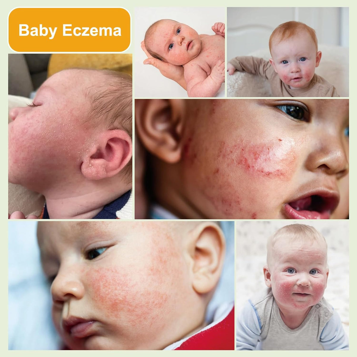 Baby Eczema Cream - Kids Eczema Therapy & Relief Body Cream, Nourishing Skin Protectant Soothes & Relieves Dry, Hypoallergenic, Fragrance & Steroid-Free (100ml_1pcs)