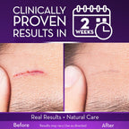 Cicatricure Advanced Scar Gel, Proven Results in 2 Weeks, 1 oz (28 g) | Scar Gel for Face & Body, Scar Treatment for Surgical Scars, Stretch Marks, Scars of Burns and Injuries, Acne Scar Treatment