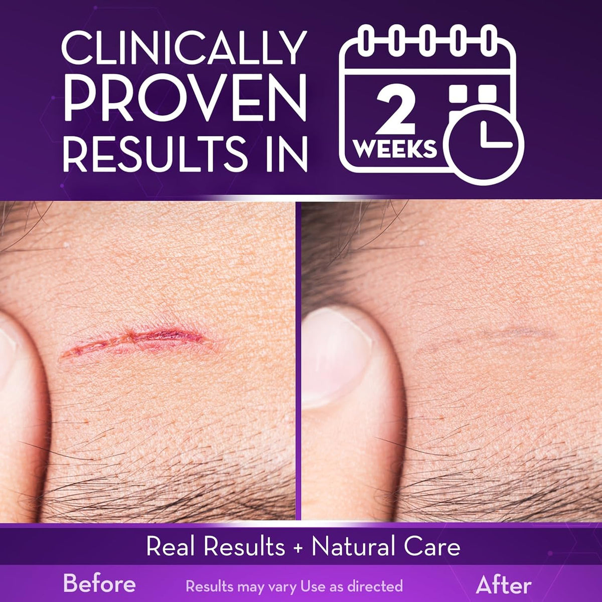 Cicatricure Advanced Scar Gel, Proven Results in 2 Weeks, 1 oz (28 g) | Scar Gel for Face & Body, Scar Treatment for Surgical Scars, Stretch Marks, Scars of Burns and Injuries, Acne Scar Treatment
