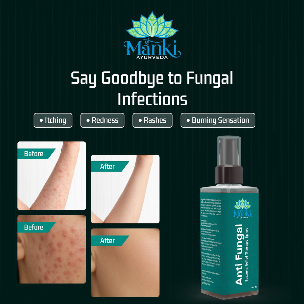 Herbal Anti Fungal Spray | Skin Care Spray for Itching, Odour & Irritation | Natural Ingredients | Suitable for Feet, Underarms & Body | 60ml