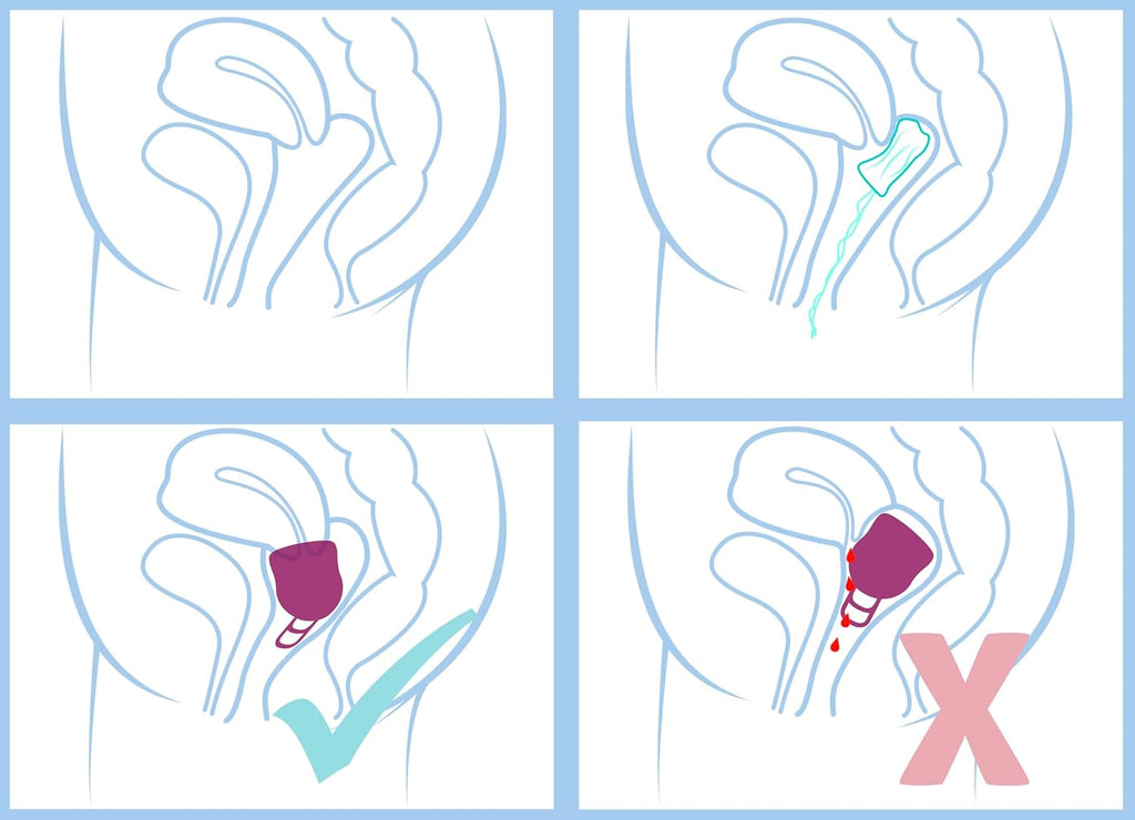 Menstrual Cups and Discs