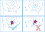Menstrual Cups and Discs