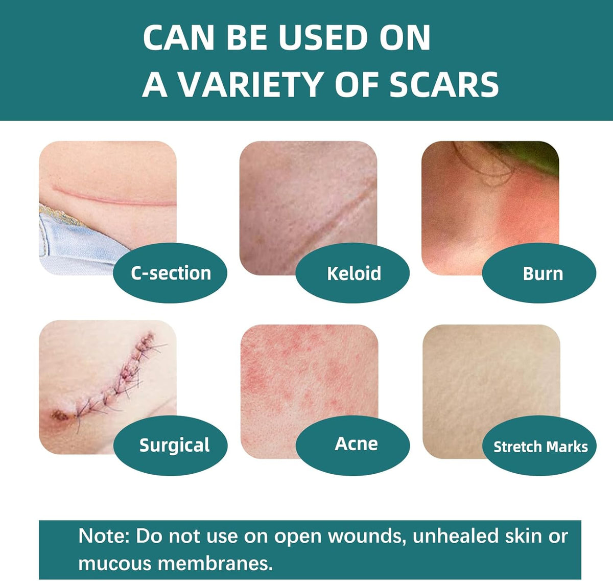 Silicone Scar Tape for Surgical Scars: 3 Meters Scar Gel Sheets for C-Section Tummy Tuck Recovery and Treatment – Reusable Scar Strips for Keloid Burn Scars Removal (1.6'' x 120'' Roll-3M)