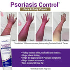 TriDerma Psoriasis Control Face and Body Cream, 4.2 Ounces
