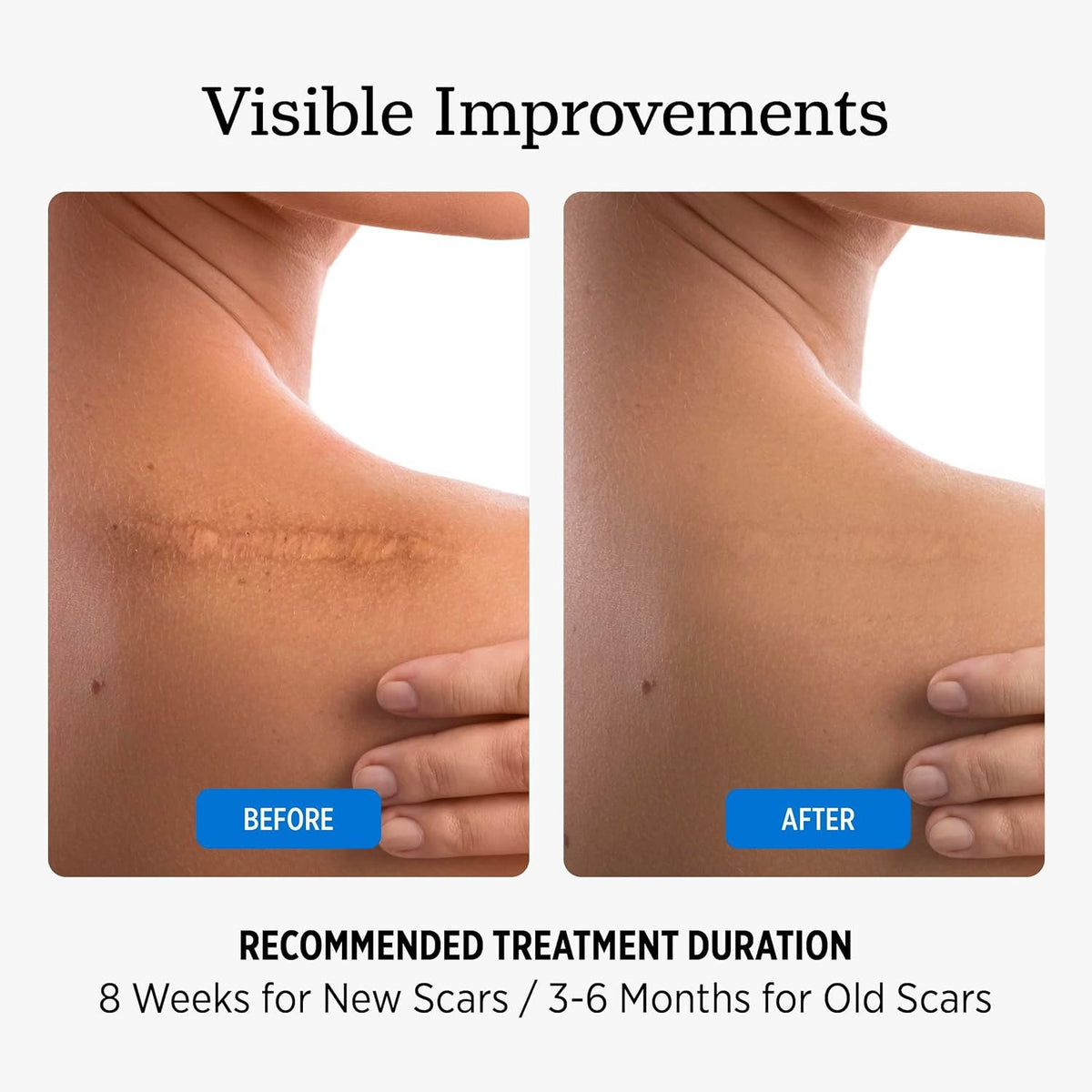 NUVADERMIS Scar Cream Gel for Surgical Scars | Retinol & Vitamin E, 1.7oz | Scar gel for surgical scars, c-section, keloid, and acne scars. Dermatologist recommended with retinol and vitamin E.