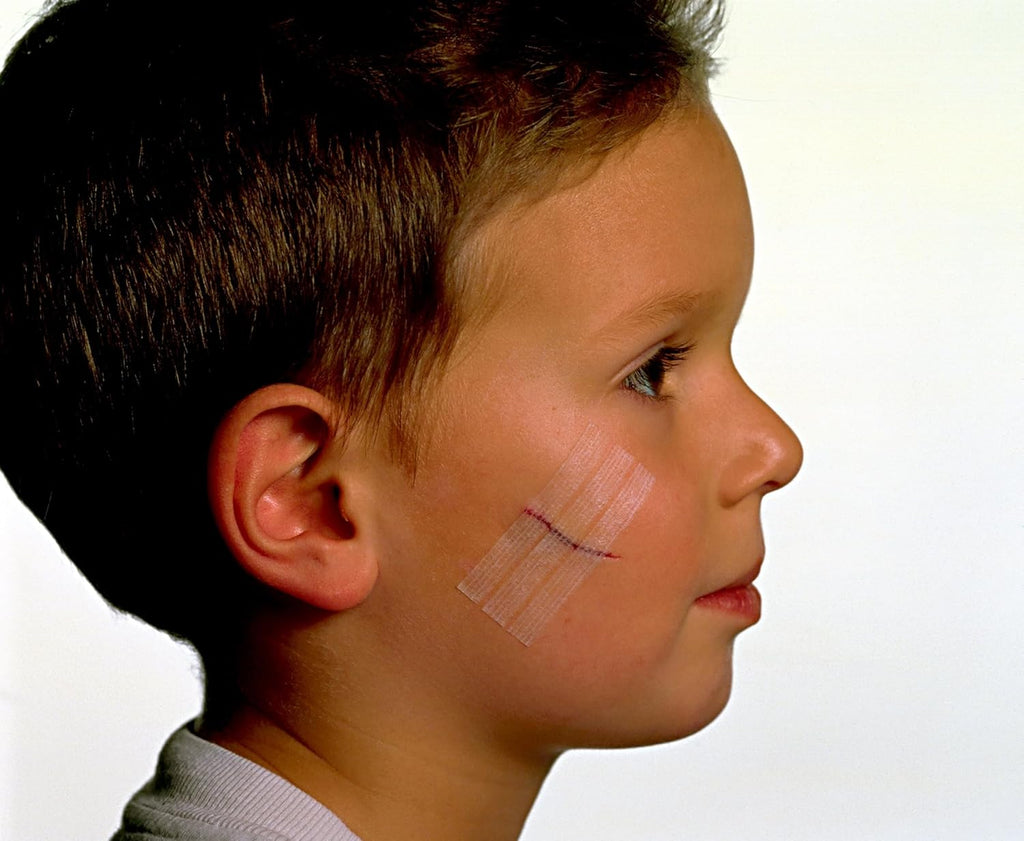 Nexcare Steri-Strip Wound Closure, Breathable Strips Hold Small Wounds Firmly Closed, Great After Sutures or Staples - 30 Wound Closures