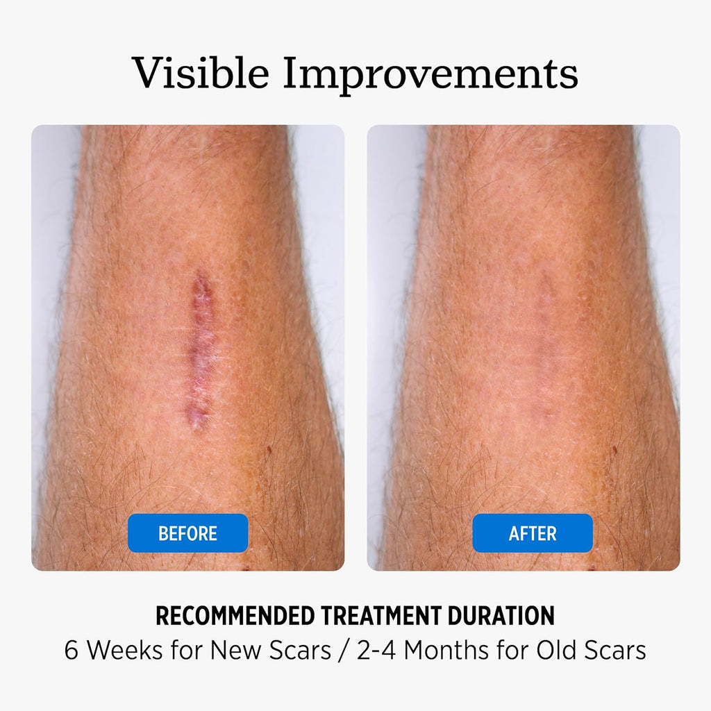 NUVADERMIS Silicone Scar Sheets for Surgical Scars - 120" x 1.5" Roll - Medical Grade Silicone Scar Tape and Face Tape for Wrinkles, Keloid Scars, and Hypertrophic Scars - Reusable - 1 Pack