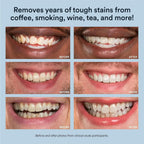 Auraglow Teeth Whitening Kit, LED Accelerator Light, 35% Carbamide Peroxide Teeth Whitening Gel, 20+ Whitening Treatments, Whitens up to 10 Shades in 7 Days